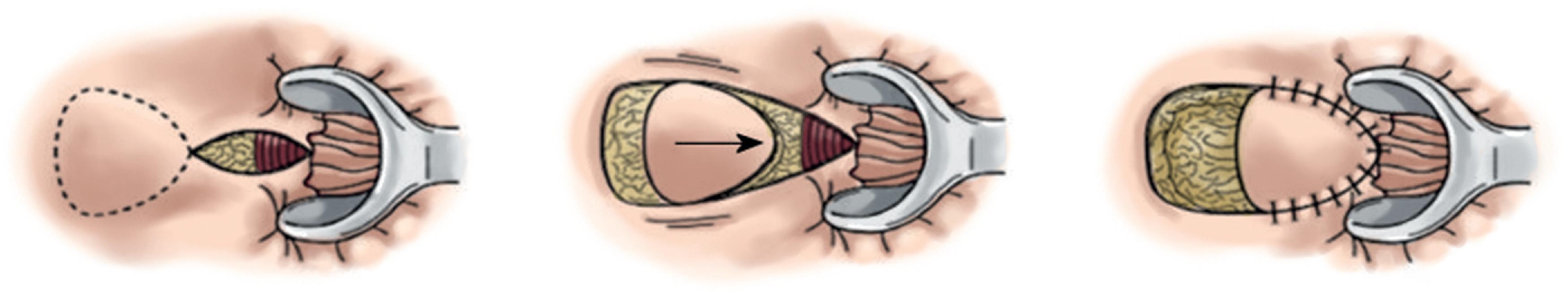 FIG. 6, U flap.