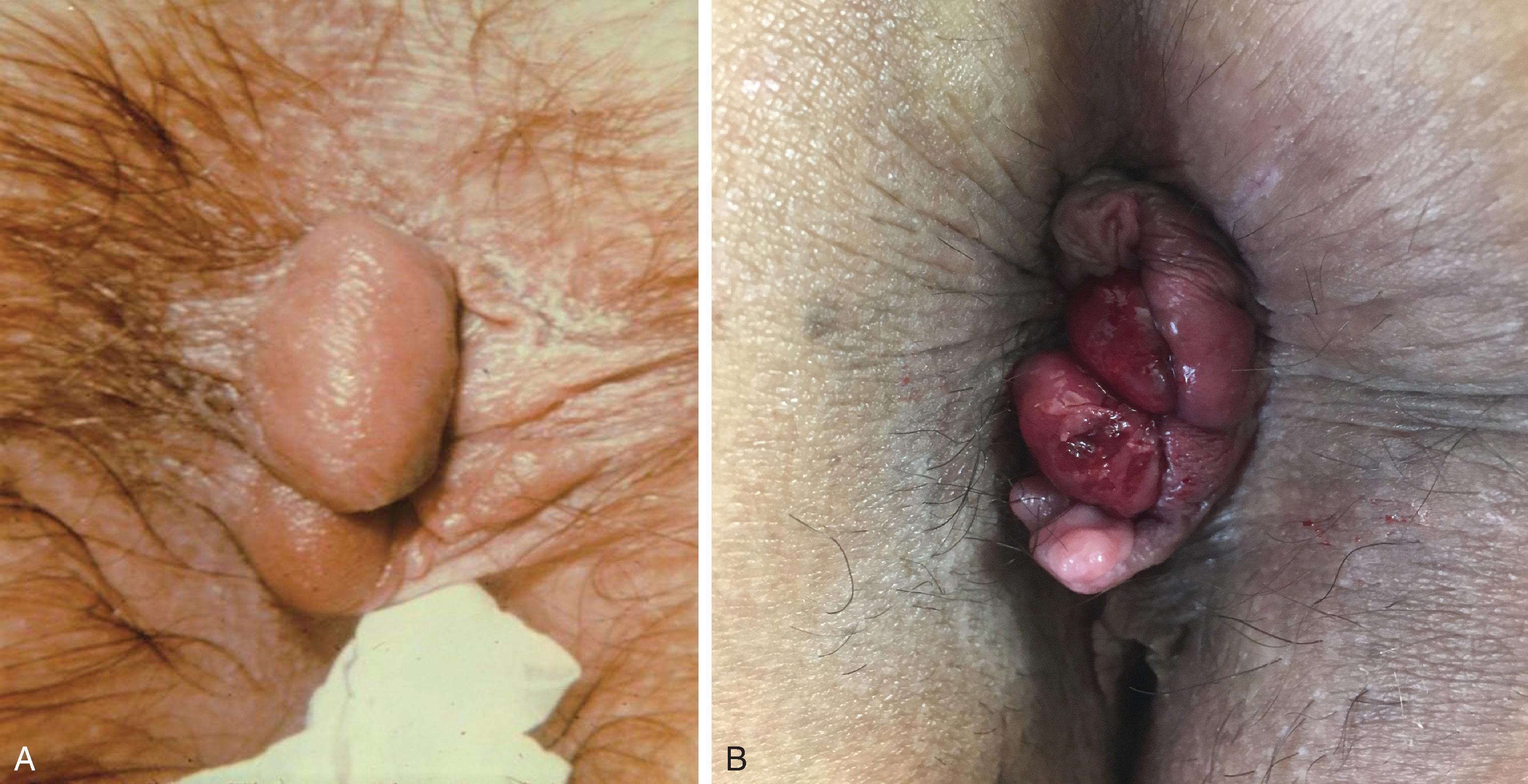 FIG. 3, (A) An acute, thrombosed external hemorrhoid. (B) Prolapsed and strangulated internal hemorrhoids with an external component.