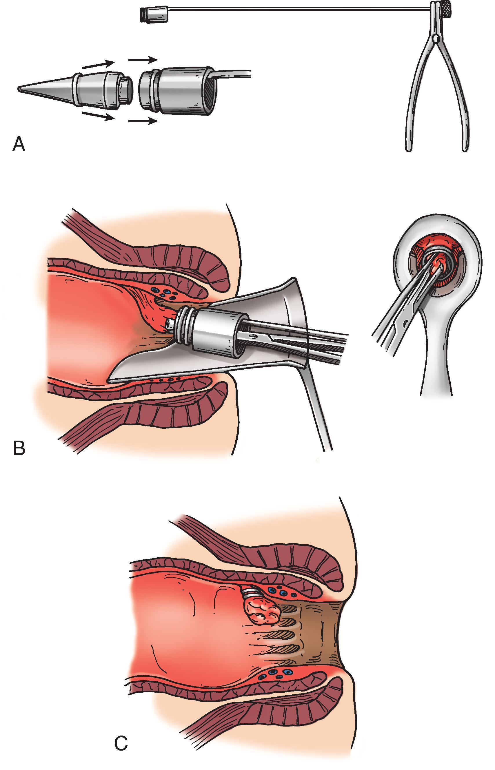 FIG. 4, Rubber band ligation of internal hemorrhoids. (A) A rubber band is placed onto a banding gun. (B) The hemorrhoid is grasped 2 cm above the dentate line, and the band is advanced over the hemorrhoid. (C) The band is shown in the correct position after ligation.