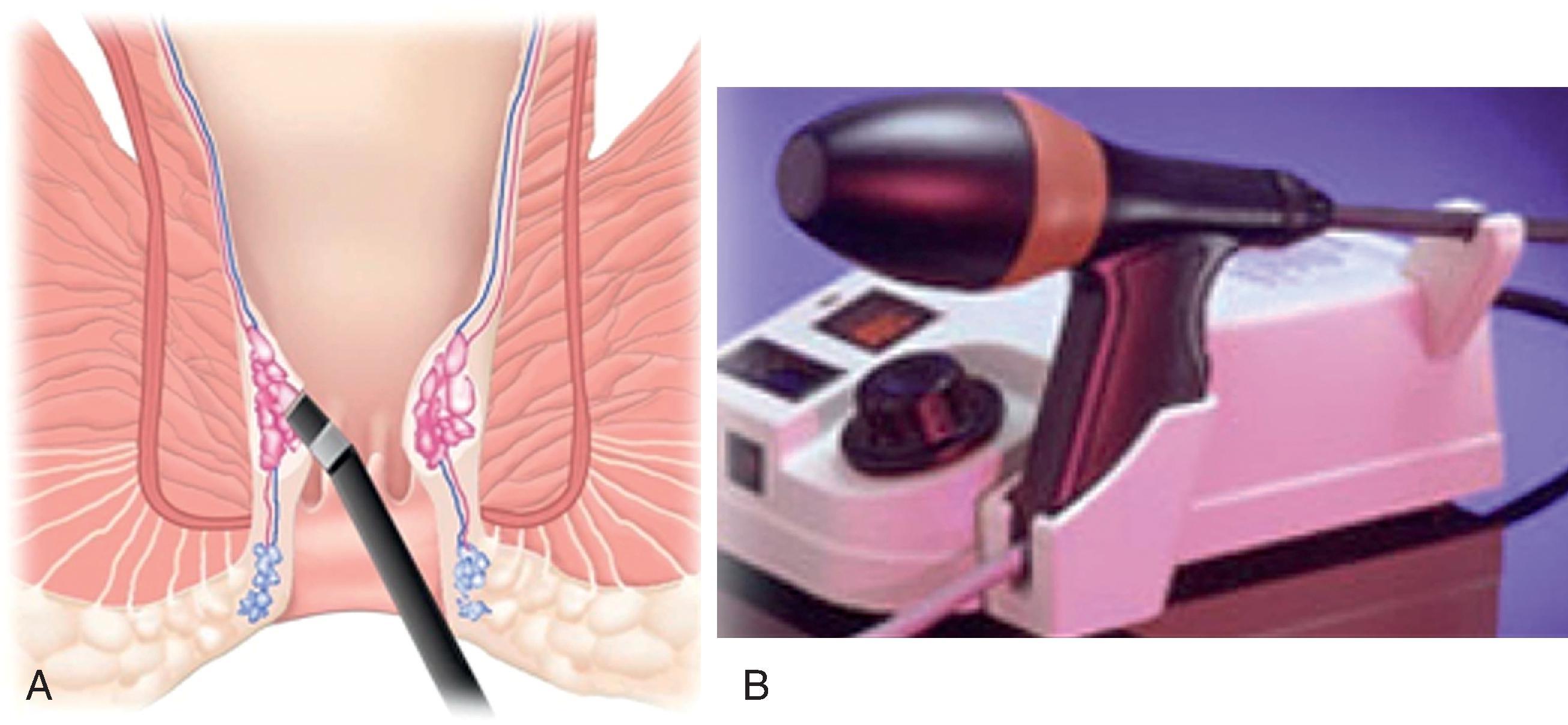 FIG. 5, Infrared coagulation of internal hemorrhoids. (A) The applicator is applied to the apex of the hemorrhoid. (B) The IRC 2100 device (Redfield Corporation).