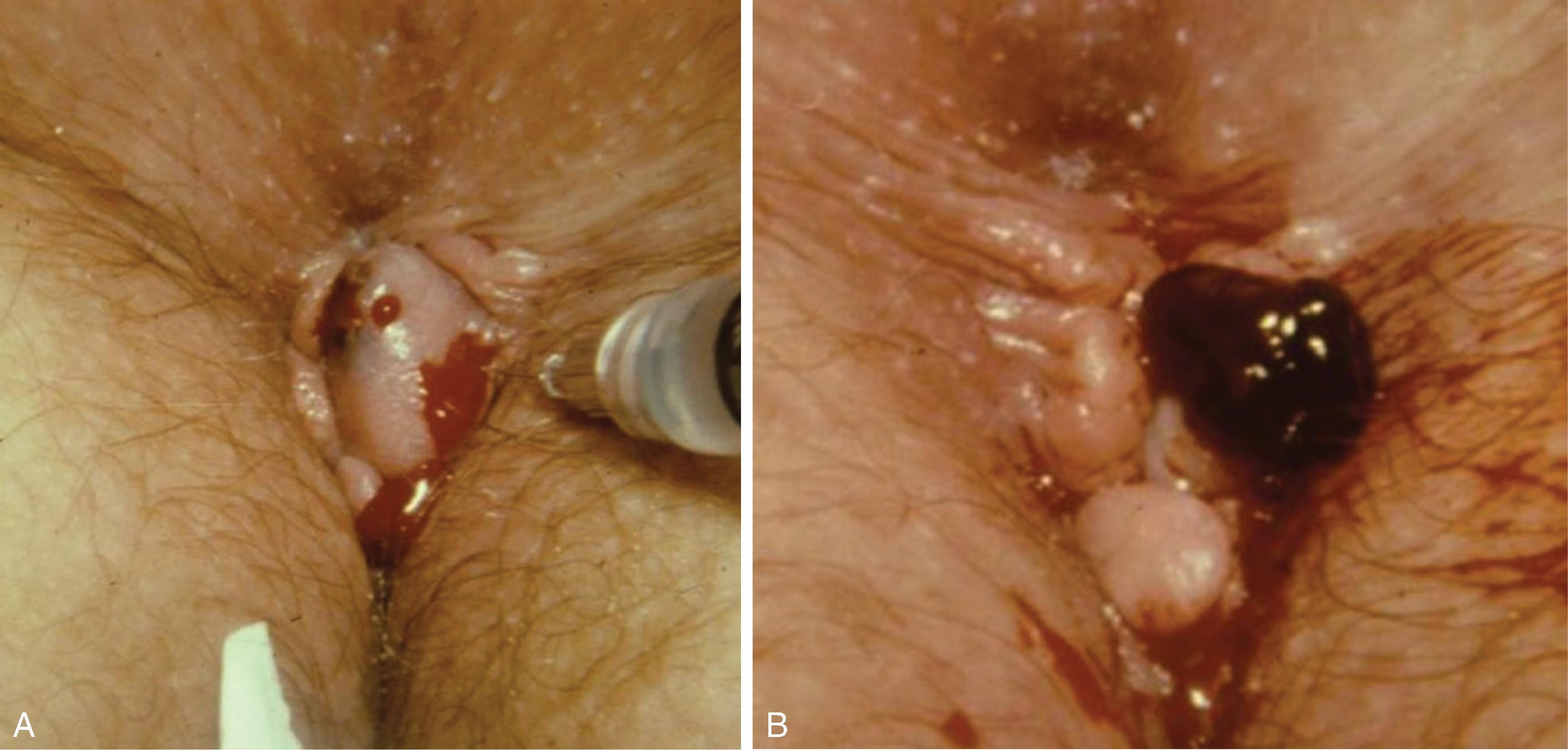 FIG. 7, Acute thrombosed external hemorrhoid. (A) Single thrombosed external hemorrhoid. (B) Clot excised with overlying.