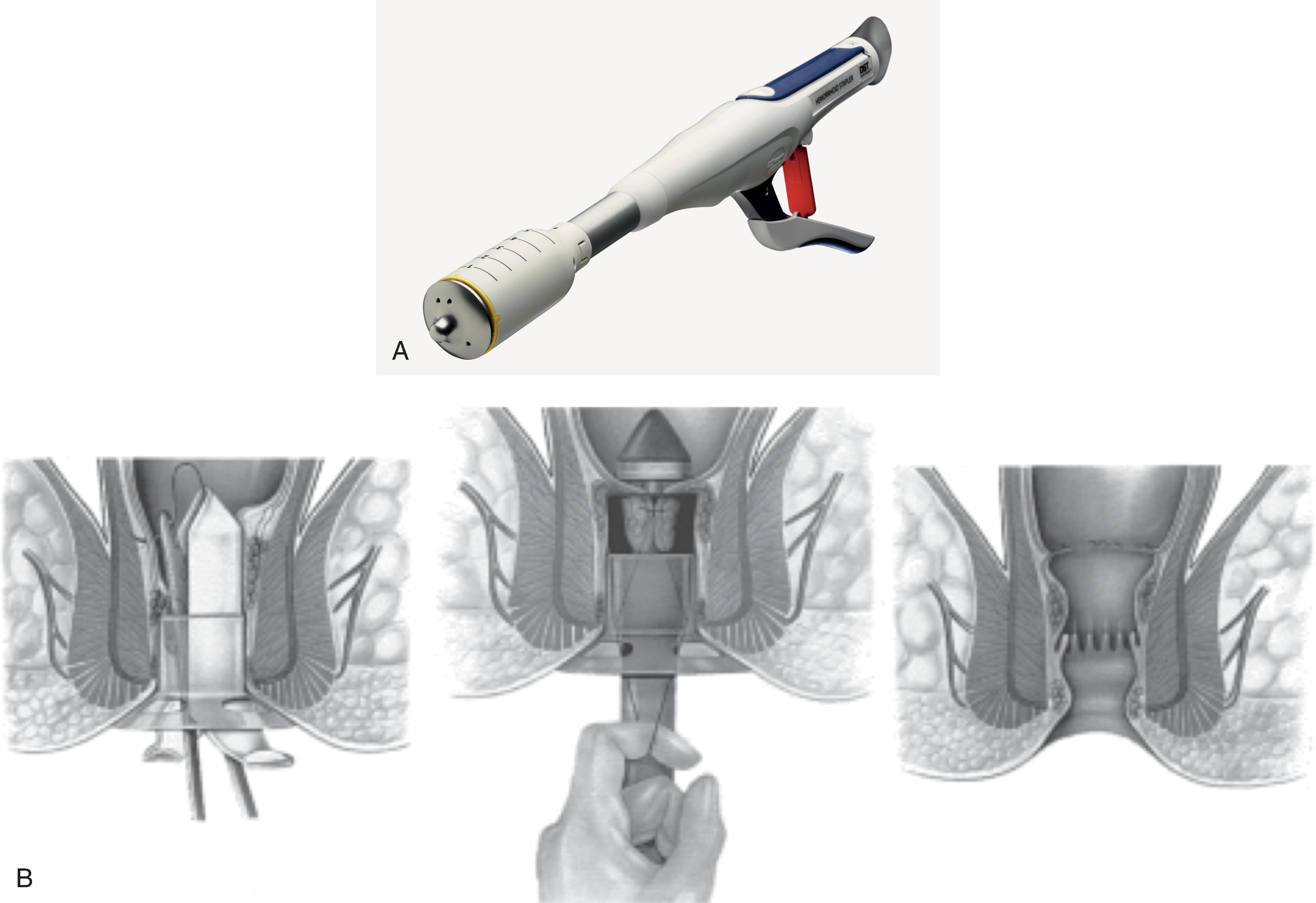 FIG. 9, (A) EEA hemorrhoid and prolapse stapler with DST Series technology. (B) Stapled hemorrhoidopexy technique. A purse-string suture is applied 4 cm above the dentate line (left). The stapler is advanced into the rectum, and traction is held on the suture (center). The staple line is shown after completion of the procedure (right).