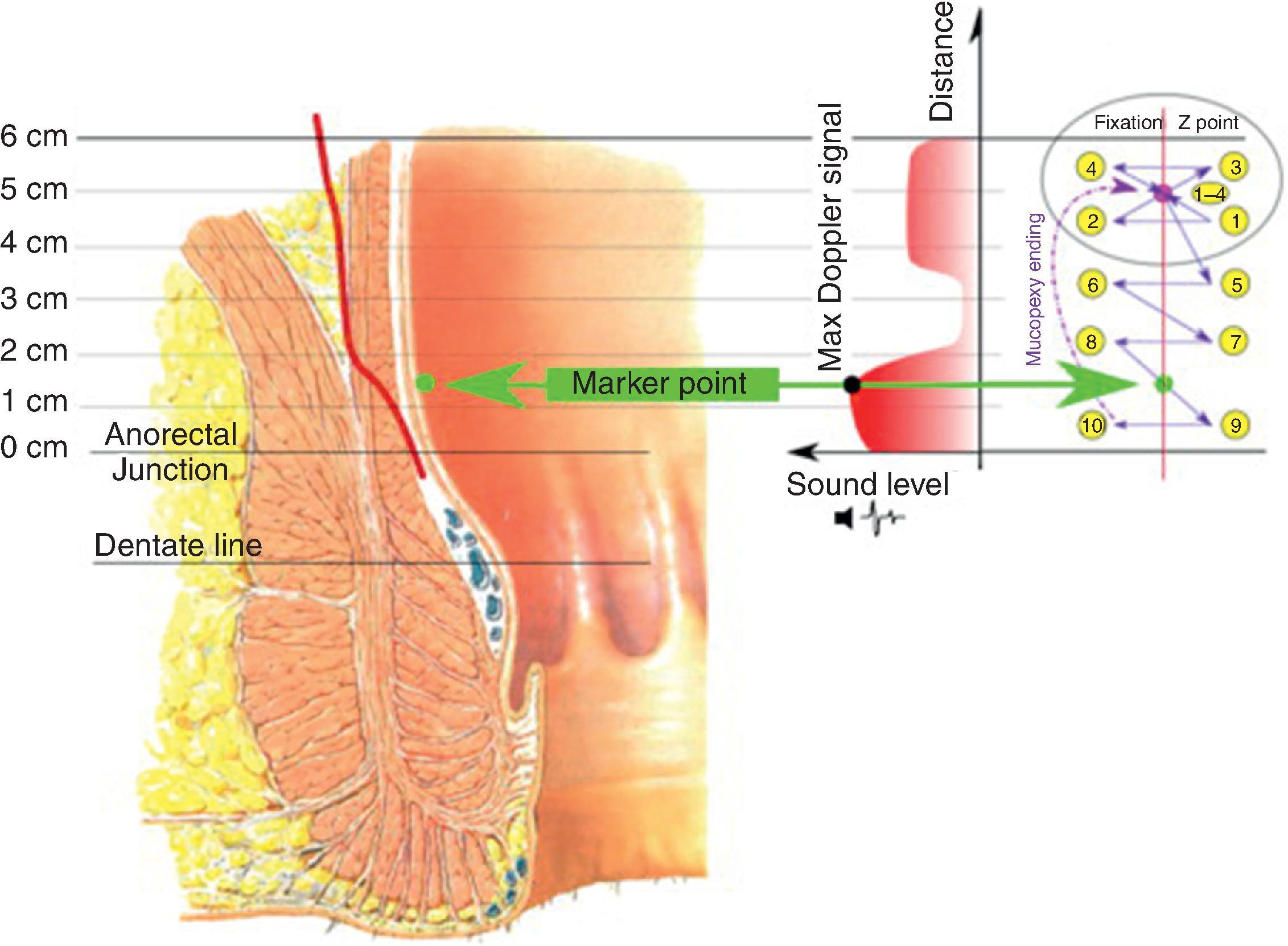 FIG. 10, Schematic of transanal hemorrhoidal dearterialization and mucopexy. Marker point denotes the location of the best Doppler signal for hemorrhoidal ligation. A Z -stitch is placed at this location for ligation alone. For higher-grade hemorrhoids, mucopexy with running suture is performed starting proximally and encompassing the ligation point, pulling the redundant mucosa up into the rectum (right side of image).