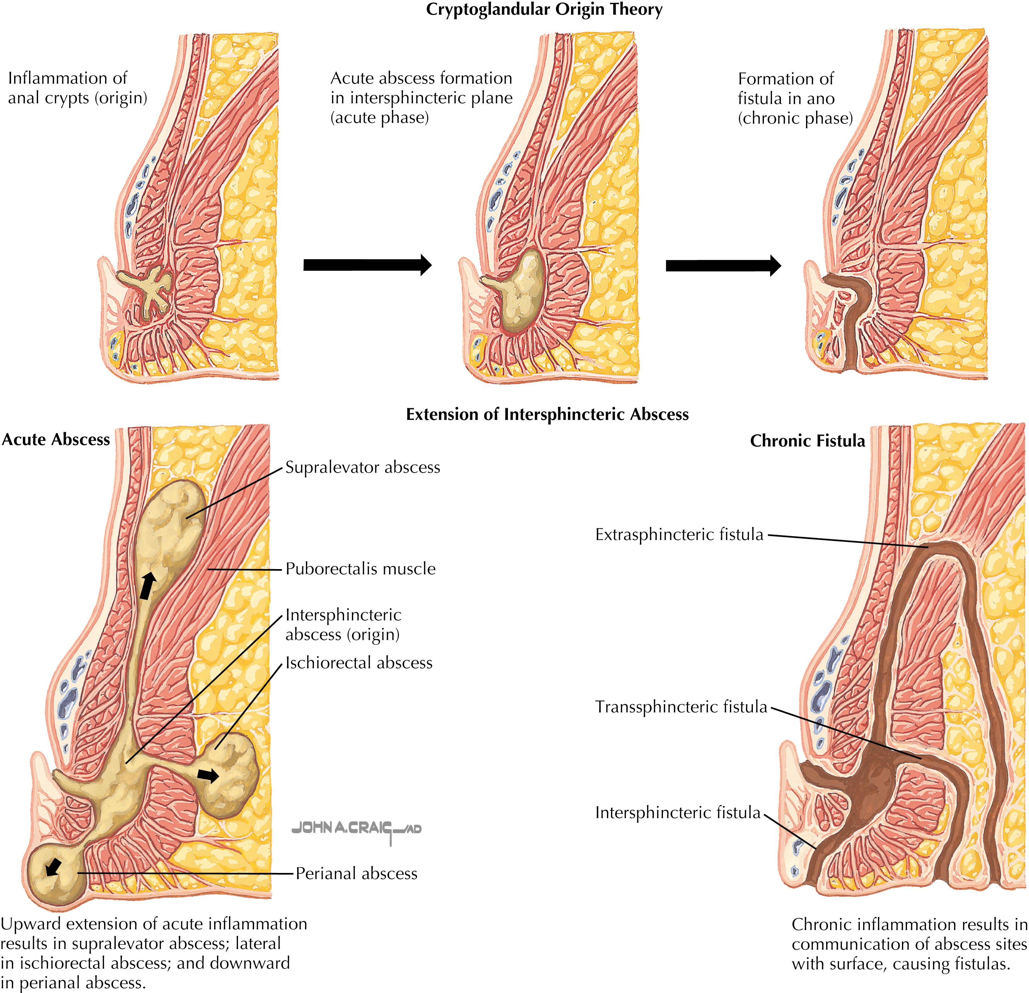 Fig. 49.1, Anorectal abscess and fistula in ano.