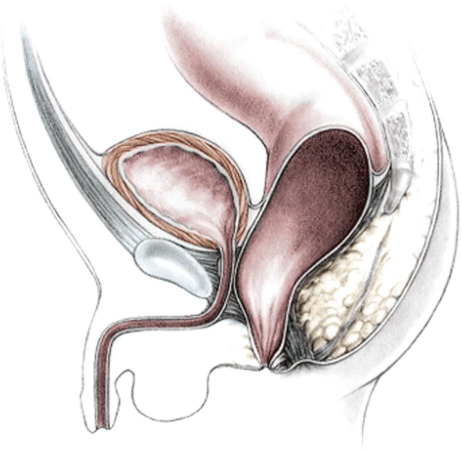 Fig. 35.1, This drawing shows the course of a perineal fistula in a male. The rectum is located within most of the muscle complex. Only the most distal aspect of the rectum is misplaced.