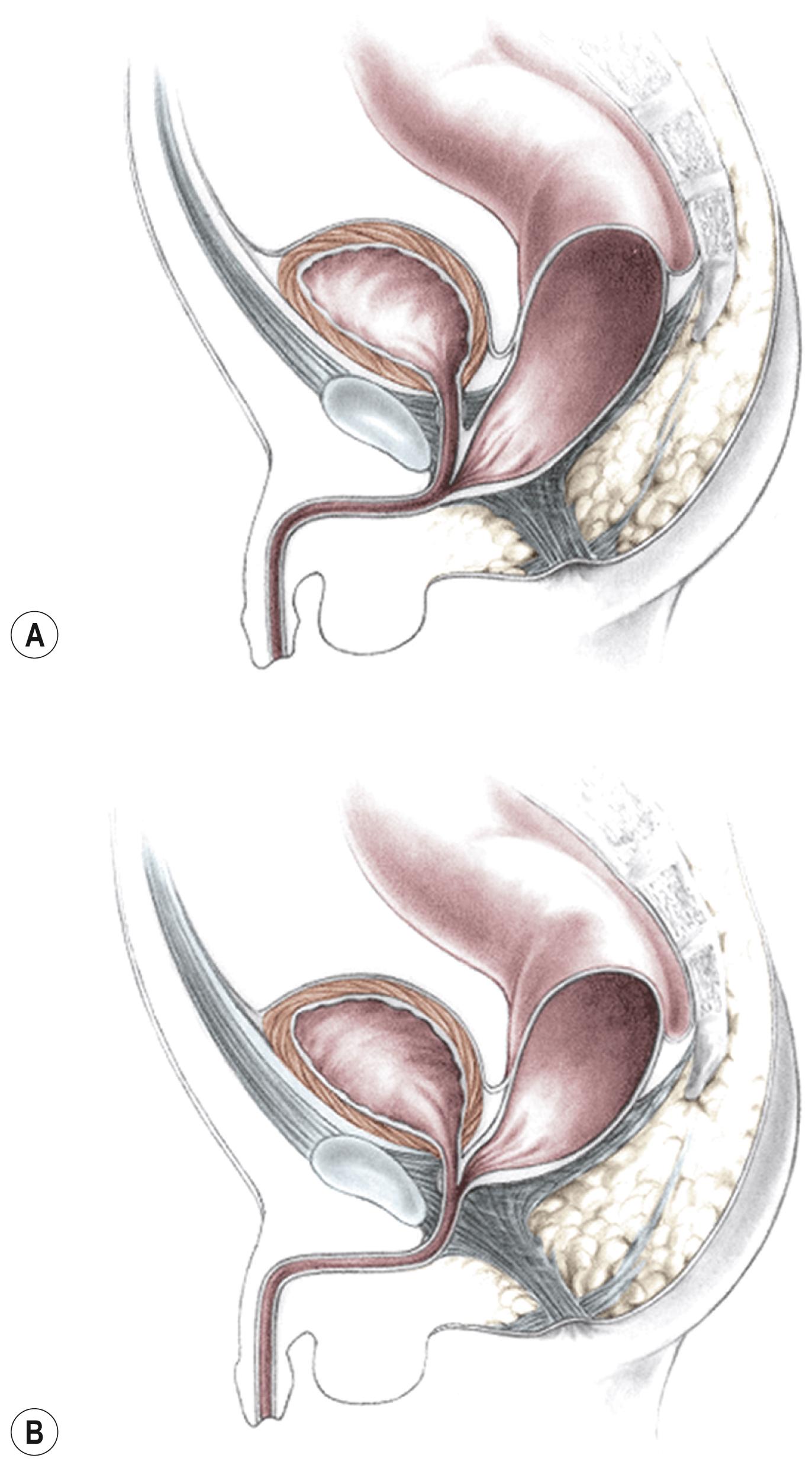 Fig. 35.3, Anorectal atresia with rectourethral fistulas. (A) Rectourethrobulbar fistula. (B) Rectourethroprostatic fistula.