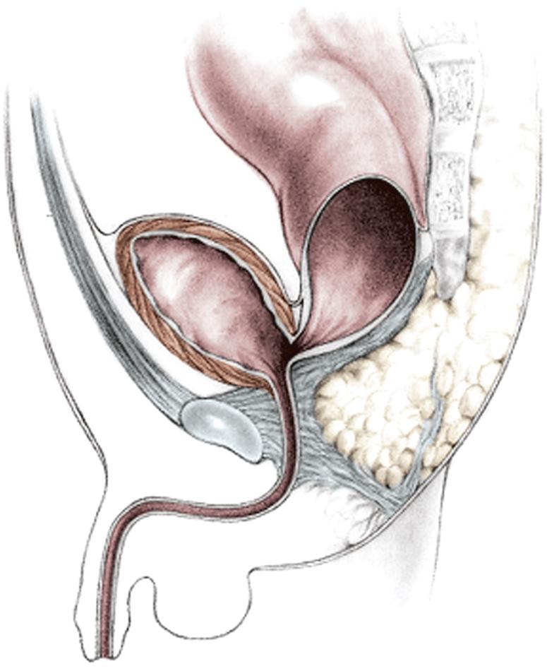 Fig. 35.4, Schematic representation of a rectobladderneck fistula. Note that the fistula enters into the bladder neck near the junction between the urethra and the bladder.