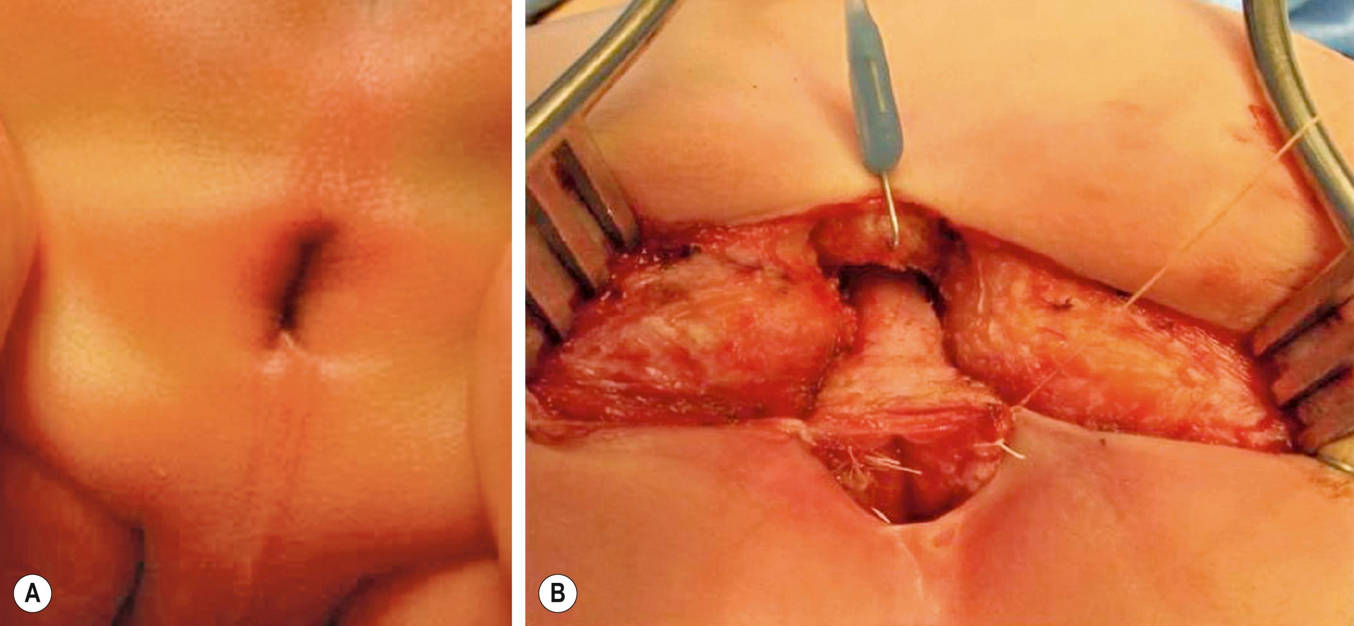 Fig. 35.5, This newborn was found to have anal stenosis. (A) Note the normal anal position and funnel shape. (B) Operative repair. A posterior sagittal incision is performed and the rectum is opened in the posterior midline through the stenotic segment into the normal caliber lumen. The normal caliber rectum becomes the posterior 50% of the reconstructed anoplasty, preserving the anterior dentate line, which becomes the anterior 180° of the anoplasty.