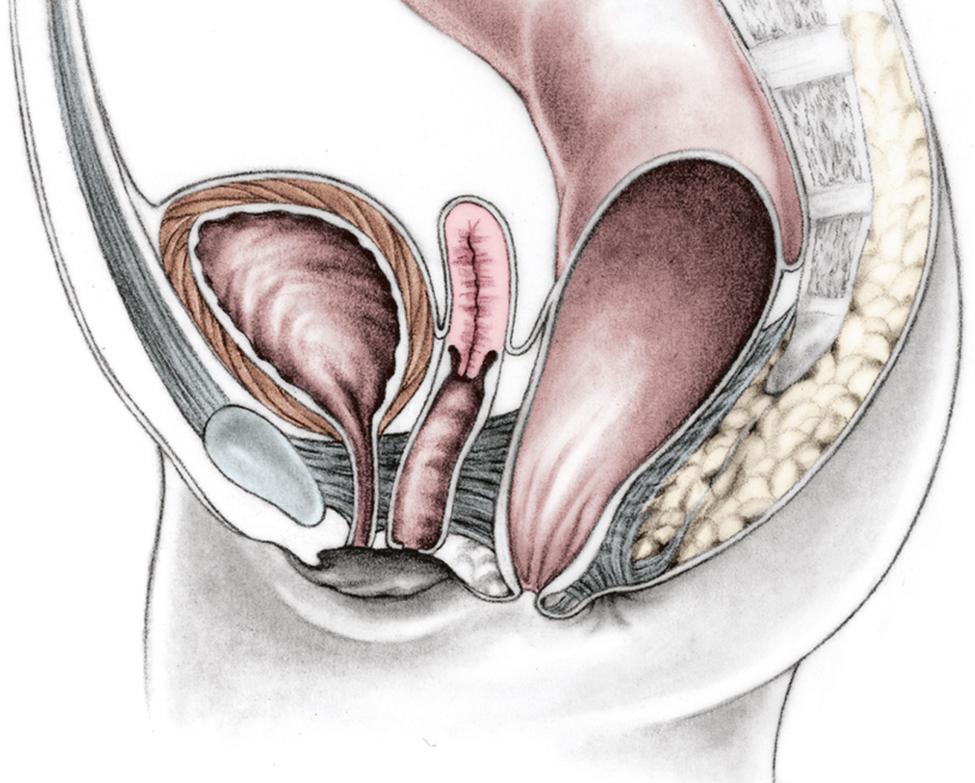 Fig. 35.6, Schematic drawing of a perineal fistula in a female. Most of the rectum is in the muscle complex. Only the most distal aspect of the rectum is anteriorly positioned.