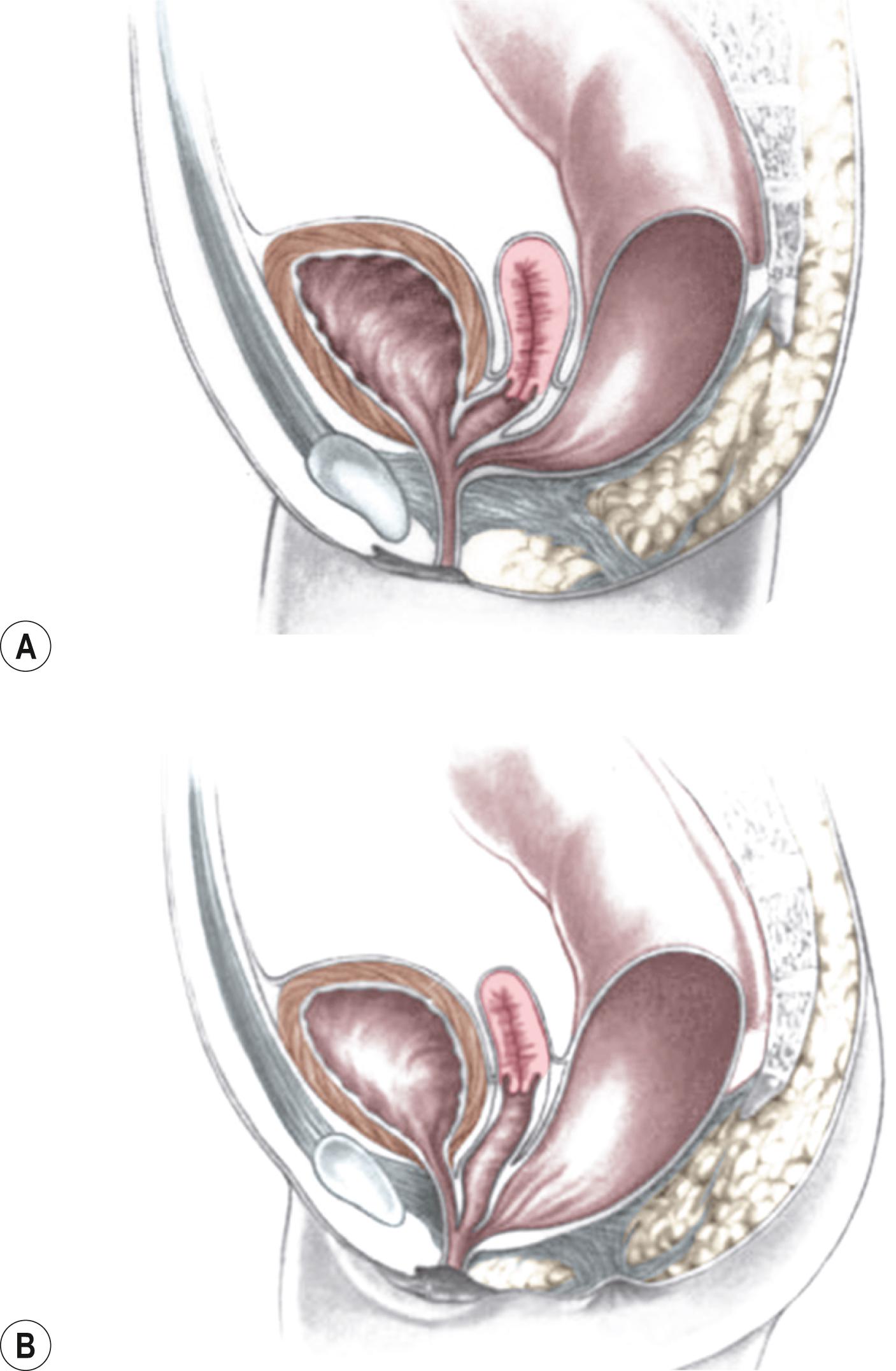 Fig. 35.8, (A) Schematic diagram of a long common channel in a female with a cloacal anomaly. (B) The more commonly encountered short common channel cloaca is depicted.