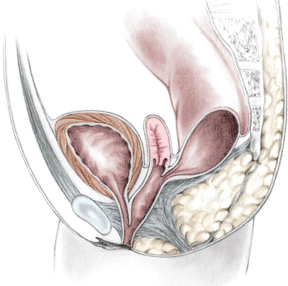 Fig. 35.9, A schematic diagram of the rectum inserting high into the posterior vagina with a short common urethral and vaginal channel is shown.