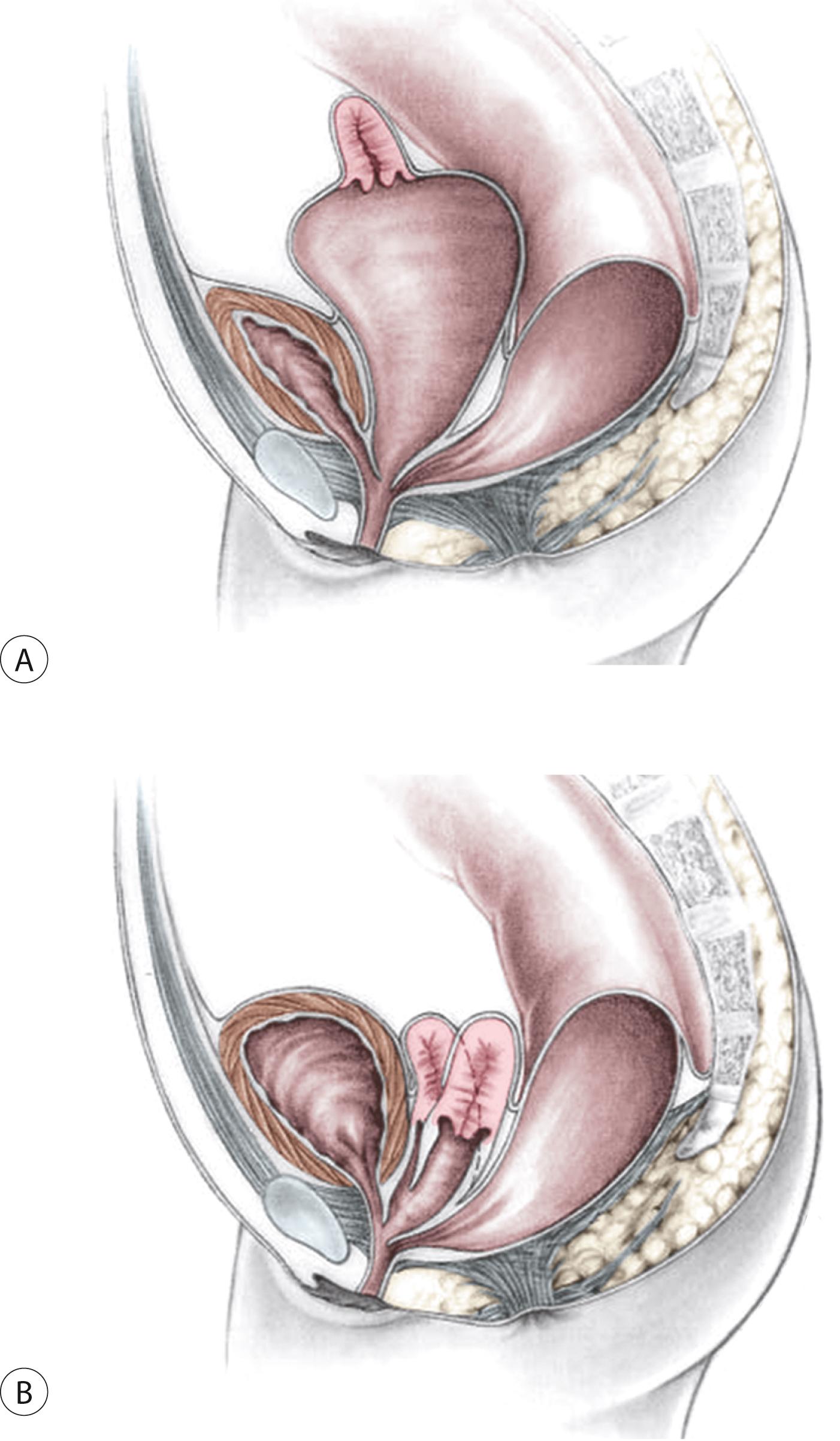 Fig. 35.10, (A) Schematic depiction of a cloacal anomaly with insertion of the rectum into the common channel and subsequent vaginal obstruction with hydrocolpos. (B) Schematic depiction of a cloacal anomaly and uterine duplication. The rectum is shown entering between the two hemivaginas.