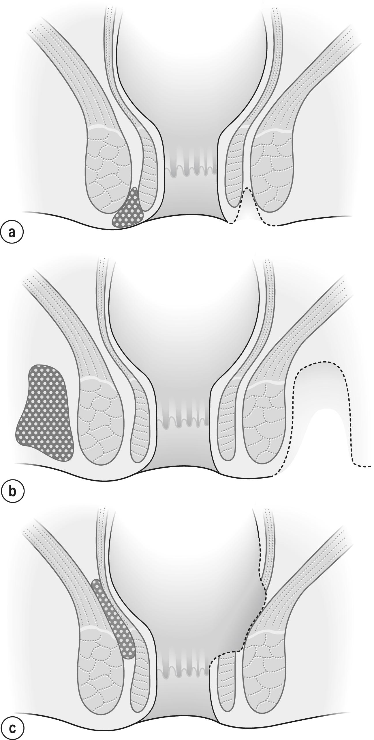 Figure 17.3, Management of specific abscesses. (a) Perianal abscess is treated by excision of a small disc of skin and curettage of the cavity. (b) Ischiorectal abscess may require excision of a substantial amount of tissue to facilitate drainage. The alternative is to introduce a drainage catheter through a small stab incision. (c) Intersphincteric abscess is treated by excision of the mucosa and internal sphincter overlying the abscess. Such an abscess should not be drained through the perineal skin or a high fistula will result.