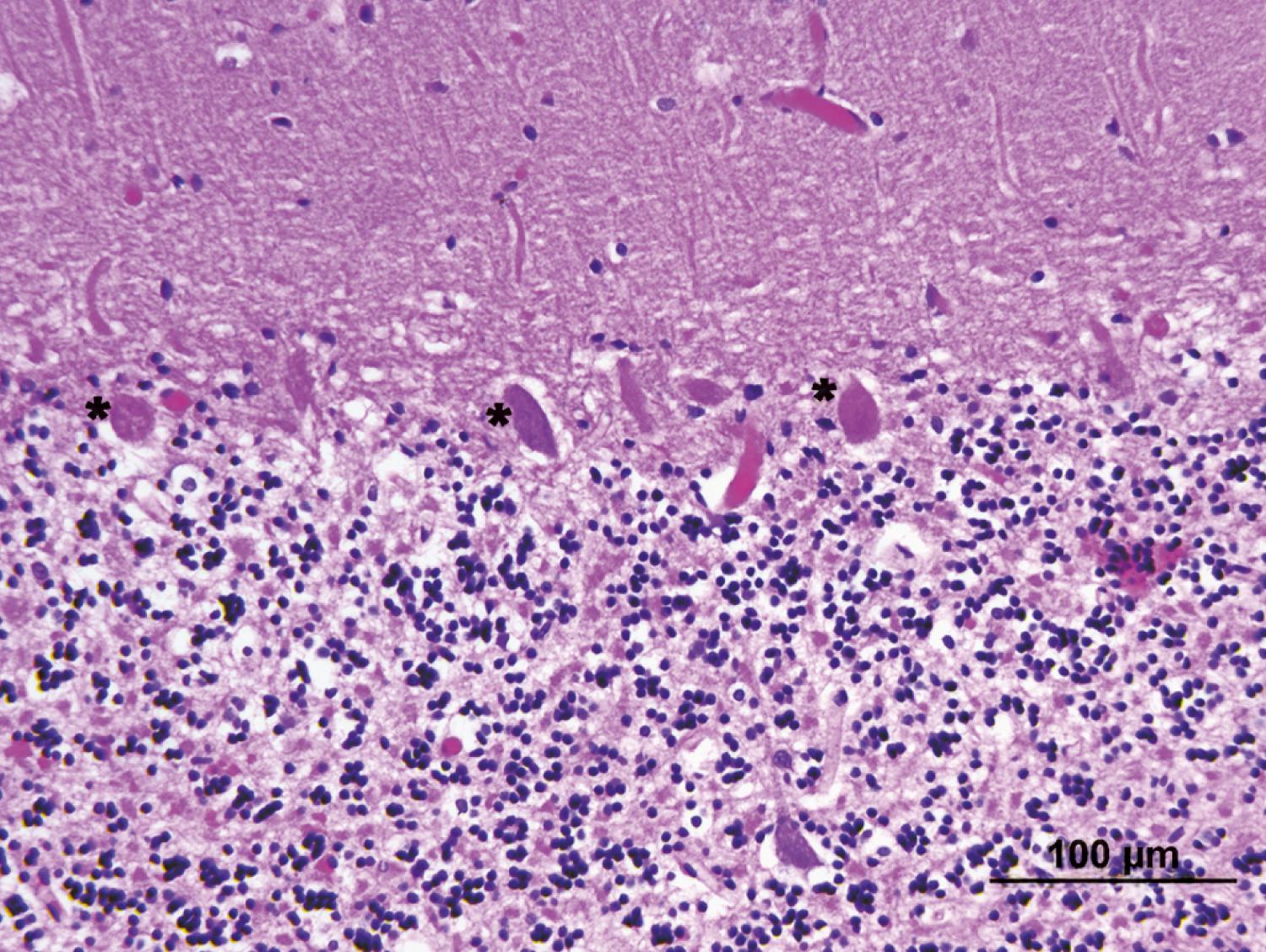 Fig. 83.2, Purkinje Cell Loss after Cardiac Arrest ( Asterisks Point to a Few Surviving Cells).