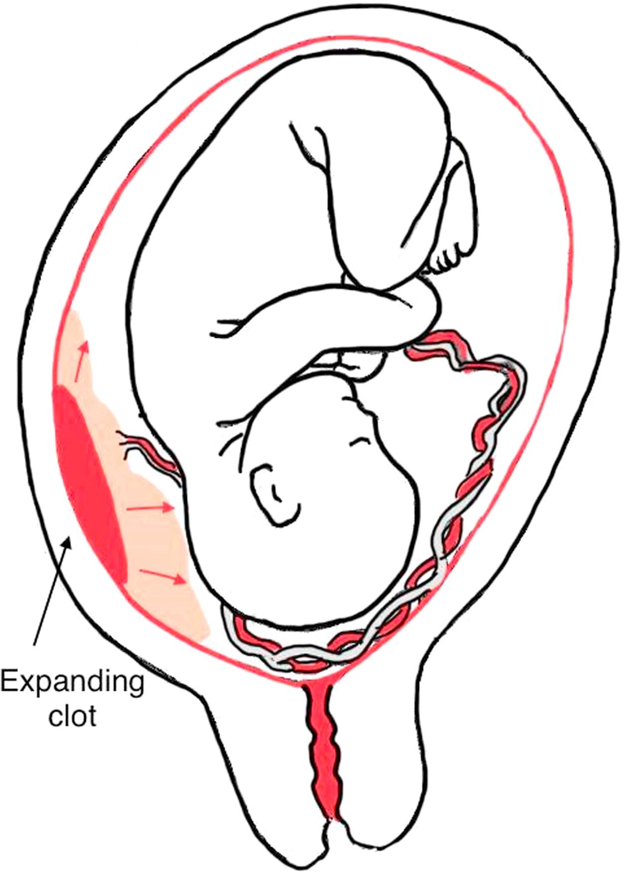 Fig. 14.1, Placental abruption. This occurs when the placenta separates from the uterine wall. It typically presents with painful vaginal bleeding.