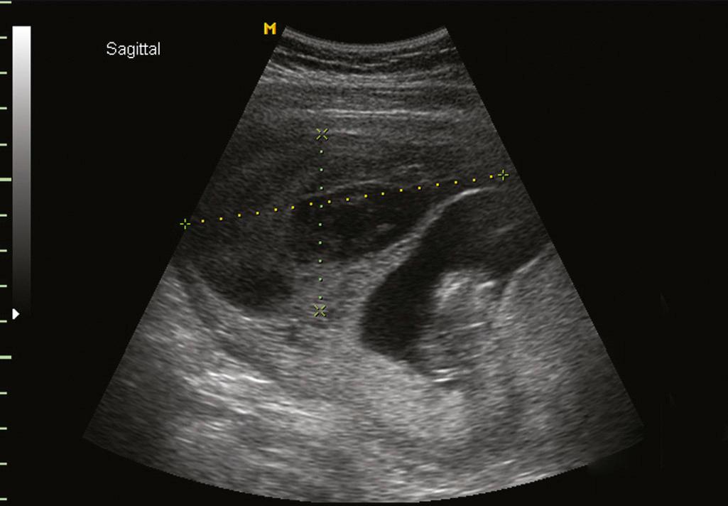 Fig. 18.3, Ultrasound Image of Subchorionic Abruption.