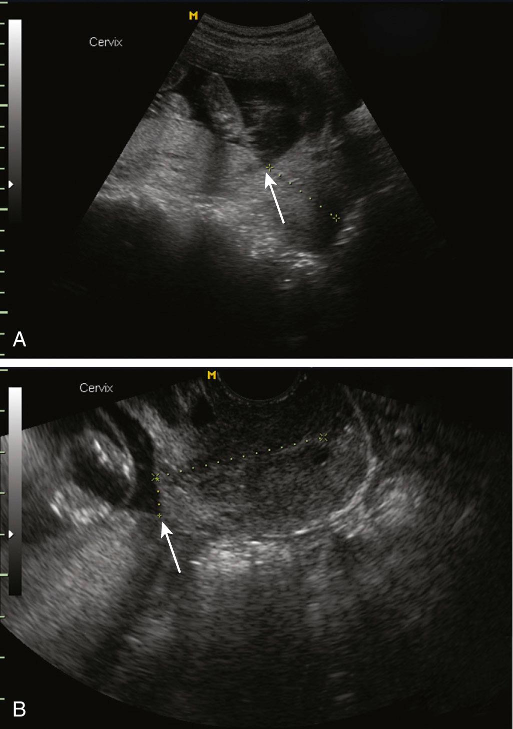 Fig. 18.5, Transabdominal (A) and Transvaginal (B) Ultrasounds of Low-Lying Placenta.