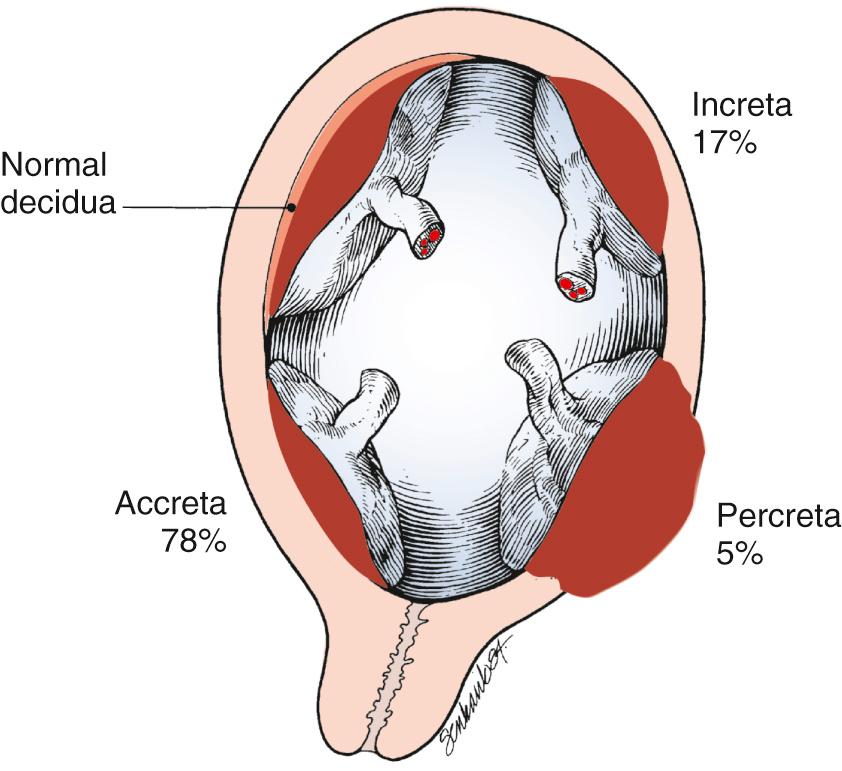 Fig. 18.7, Uteroplacental Relationships Found With Placenta Accreta Syndrome.