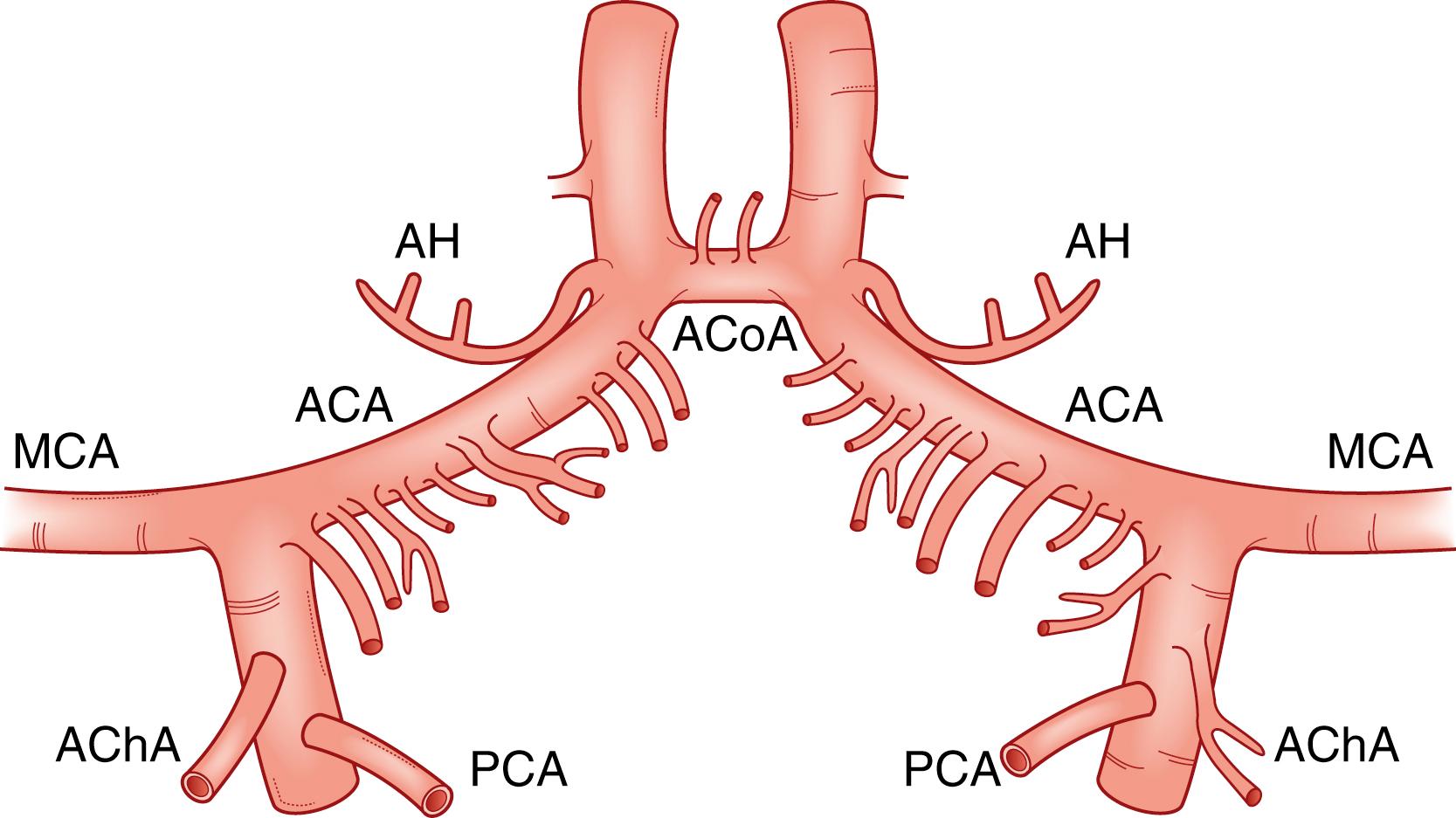 Fig. 23.1, Diagram of the dorsal surface of the anterior circle of Willis, showing branches from the A1 segment of the anterior cerebral artery and from the anterior communicating artery. ACA , Anterior cerebral artery; AChA , anterior choroidal artery; ACoA , anterior communicating artery; AH , artery of Heubner; MCA , middle cerebral artery; PCA , posterior communicating artery.