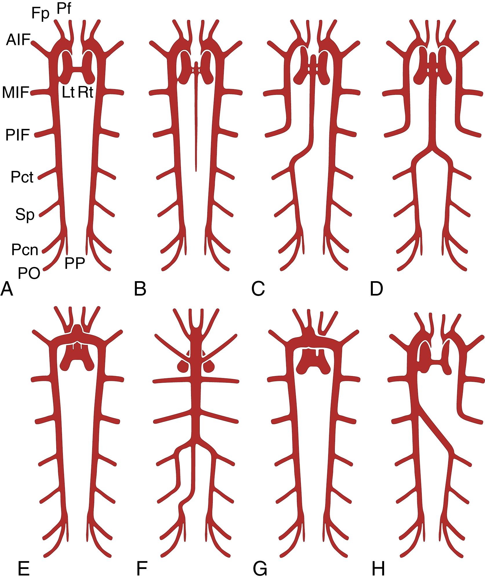 Fig. 23.3, Variations in the distal anterior cerebral artery including patterns without (A) and with (B) a medial artery of the corpus callosum and variously developed accessory (C–E), unpaired (F), and bihemispheric lateral arteries (G and H). AIF , Anterior internal frontal; Fp , frontopolar; MIF , middle internal frontal; Pcn , precuneal; Pct , paracentral; Pf , prefrontal (orbitofrontal); PIF , posterior internal frontal; PO , parieto-occipital; PP , posterior pericallosal; Sp , superior parietal.