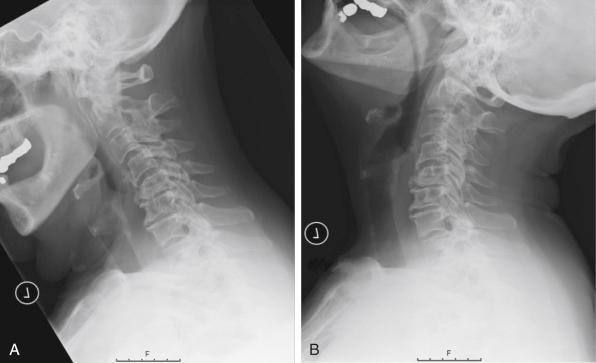 FIGURE 31-1, Preoperative flexion ( A ) and extension ( B ) radiographs show multilevel spondylosis from C3 to C7. The extension view shows that the patient’s alignment does correct into lordosis.