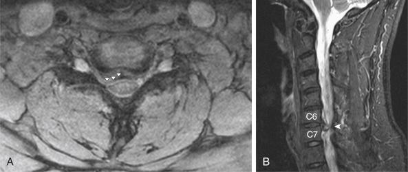 FIGURE 30-1, Axial ( A ) and parasagittal ( B ) T2-weighted magnetic resonance imaging demonstrating a large paracentral right-sided C6-7 herniated cervical disk ( arrowheads ).