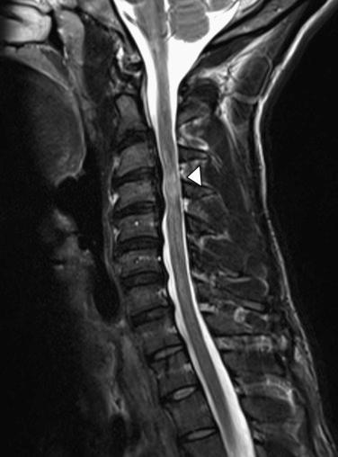 FIGURE 30-2, Sagittal T2-weighted magnetic resonance imaging demonstrated cervical stenosis with spinal cord signal change ( arrowhead ).