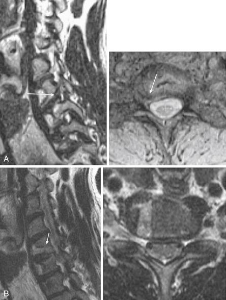 FIGURE 33-1, A , Preoperative cervical magnetic resonance imaging (MRI) shows foraminal disk herniation at the C6-C7 level compressing the right C7 nerve root ( arrows ). B , Postoperative MRI shows complete removal of the herniated disk fragment and decompression of the C6-C7 neural foramen ( arrow ).