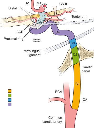 Figure 17.1, The segments of the carotid artery. The segments of the internal carotid artery are as follows: cervical segment, or C1; petrous segment, or C2; lacerum segment, or C3 (together C2 and C3 compose the “petrous portion”); cavernous segment, or C4, (functionally identical to the commonly used “cavernous portion”); clinoidal segment, or C5; ophthalmic or supraclinoid segment, or C6; and communicating or terminal segment, or C7 (C6 and C7 together constitute the commonly used “supraclinoid segment”).