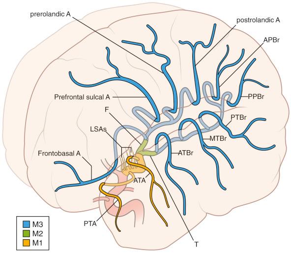 Figure 17.3, The middle cerebral artery is divided into four segments, M1 through M4. M1 includes the medial and lateral lenticulostriates, the anterior temporal artery, the polar temporal artery, and, variably, the uncal artery. The M2 branches include the frontal and temporal branches, and named branches from these are considered M3 branches. The frontal branch includes the frontobasal artery, the prefrontal sulcal artery, and the pre-/postrolandic arteries. The temporal branches include anterior, middle, and posterior branches as well as the anterior and posterior parietal branches. M4 is composed of arterial branches emerging from the named branches within the Sylvian fissure onto the convex surface of the hemisphere, also known as the cortical segments.