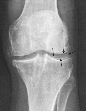 FIG 7-1, The “ring” sign ( arrows ) represents an osteophyte that forms around the circumference of the lateral tibial plateau with degenerative arthritis and meniscectomy, which commonly reduces the pivot shift phenomena caused by increased plateau concavity that limits anteroposterior (AP) translation.