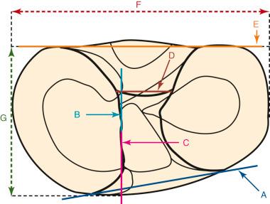 FIG 7-11, Schematic diagram of the tibial plateau depicting the landmarks used in this study. A, Anterior tibial surface; B, apex of medial tibial spine; C, lateral border of medial tibial spine; D, “over the back” ridge; E, posterior tibial axis; F, width; G, depth.