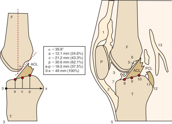 FIG 7-13, Schematic drawing of tibial insertion of anterior cruciate ligament (ACL) and its orientation with the knee in extension. In this cryosectional knee specimen (right knee, midsagittal plane, medial view at 0 degrees of flexion, that is, in the extended knee position, specimen 5), the inclination of a tangent constructed to the intercondylar roof formed an angle of 42 degrees with respect to the midsagittal femoral shaft axis. The anterior limit of the ACL was located at 11 mm (23.4%), the central part at 20 mm (42.6%), and the posterior limit at 29 mm (61.7%) when determined from the anterior tibial margin and calculated over the total sagittal diameter of the tibia, which measured 47 mm (100%). F , femur; P , patella; T , tibia; 1, quadriceps tendon; 2, patellar tendon; 3, Hoffa's fat pad (corpus adiposum intrapatellare); 4, infrapatellar plica; 5, synovial fold of posterior cruciate ligament (PCL); 6, roof of intercondylar fossa; 7, anterior tibial margin; 8, anterior limit of ACL; 9, central part of ACL; 10, posterior limit of ACL; 11, tibial attachment site of PCL at posterior intercondylar area; 12, posterior tibial margin at posterior intercondylar area; 13, popliteal artery.