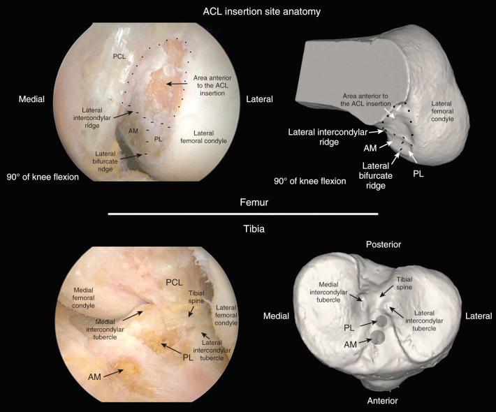 FIG 7-14, Following careful arthroscopic dissection and removal of soft tissue remnants, key insertion site anatomy was identified. On the femoral side, the lateral bifurcate and intercondylar ridges were identified. On the tibial side, the tibial spine, the medial and lateral intercondylar tubercles, and the posterior cruciate ligament were identified. Corresponding 3-dimensional computed tomography reconstructions delineate these topographic osseous landmarks. ACL , Anterior cruciate ligament; AM , anteromedial; PCL , posterior cruciate ligament; PL , posterolateral.