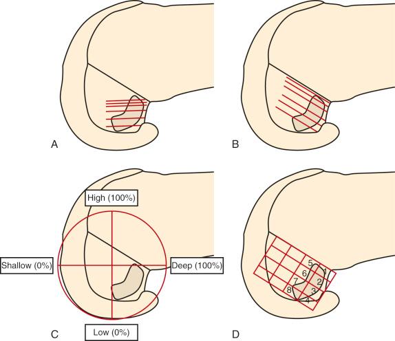 FIG 7-17, A, Measurement lines drawn parallel to the femoral shaft at clock-face positions. B, Measurement lines drawn parallel to the femoral notch roof from clock-face positions. C, The posterior condyle circle reference system. D, Measurement grid for describing the position of the centers of the two functional anterior cruciate ligament bundle attachments, with numbered zones.