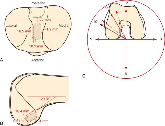 FIG 7-19, A, Right knee anterior cruciate ligament (ACL) tibial insertion. Measurements are the mean for the anterior-posterior length, medial-lateral width 10 mm from the posterior margin, distance from the posterolateral cruciate ligament notch, and distance to the medial plateau articular cartilage. B, Right knee ACL femoral insertion. Measurements are the mean for the length, width 10 mm from the proximal margin, distance to the articular cartilage, and angle to the long axis of the femur in the sagittal plane. C, Right knee ACL femoral insertion in the coronal plane with the knee flexed 90 degrees. The ACL insertion spanned the clock face from 10:14 to 11:23. The vertical 12 o'clock axis was perpendicular to the 3 to 9 o'clock axis drawn between the posterior femoral condyles. The vertical axis extended superiorly from a point midway between the walls of the notch to the apex of the notch.