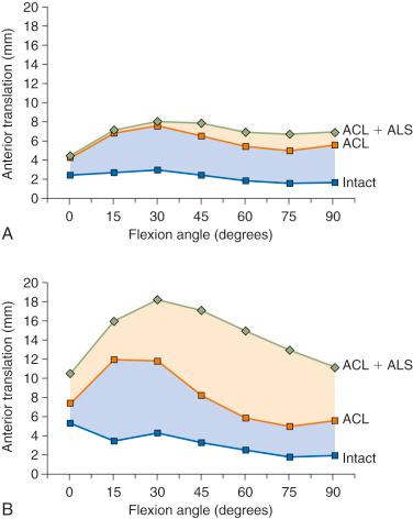 FIG 7-2, Limits of anterior translation (100 N) for intact specimens and with the anterior cruciate ligament (ACL) and ACL/iliotibial band lateral capsule (ALS) cut. A, In these specimens, anterior translation in the intact state was low and, with sectioning of the ACL, moderate increases were found throughout the range of motion. Further sectioning of the ALS produced less than 3 mm of an increase in anterior translation, predominantly in the flexed knee. B, In this group of specimens, anterior translation in the intact state was higher than in the prior group of specimens at low flexion angles. After cutting the ACL, anterior translation was markedly increased in the 15 to 30 degrees of flexion range. After further sectioning of the ALS, large anterior translation increases were found at all flexion angles, indicating the ALS is a secondary restraint.