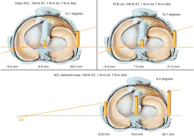 FIG 7-26, A representative right knee specimen showing compartment translations and tibial rotation under pivot shift 4 loading conditions (100-N anterior, 1 N-m internal rotation, 7 N-m valgus) for intact, posterolateral bundle (PLB) cut, and anterior cruciate ligament (ACL)-deficient states. PLB sectioning alone resulted in no statistically significant change in tibiofemoral compartment translations. Abd , Abduction; AT , anterior translation; CR , center of tibial rotation; Int , internal.