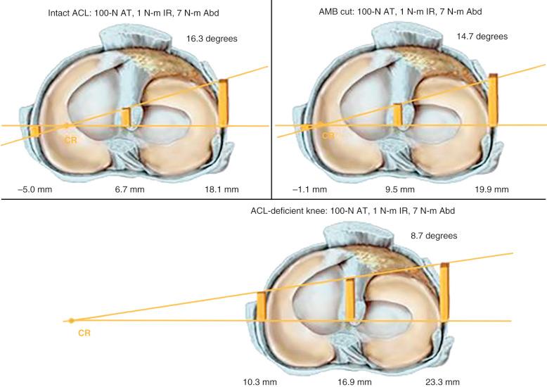 FIG 7-27, A representative right knee specimen showing compartment translations and tibial rotation under pivot shift 4 loading conditions (100-N anterior, 1 N-m internal rotation, 7 N-m valgus) for intact, anteromedial bundle (AMB) cut and anterior cruciate ligament (ACL)-deficient states. AMB sectioning alone resulted in a small but statistically significant change in tibiofemoral compartment translations. Abd , Abduction; AT , anterior translation; CR , center of tibial rotation; Int , internal.