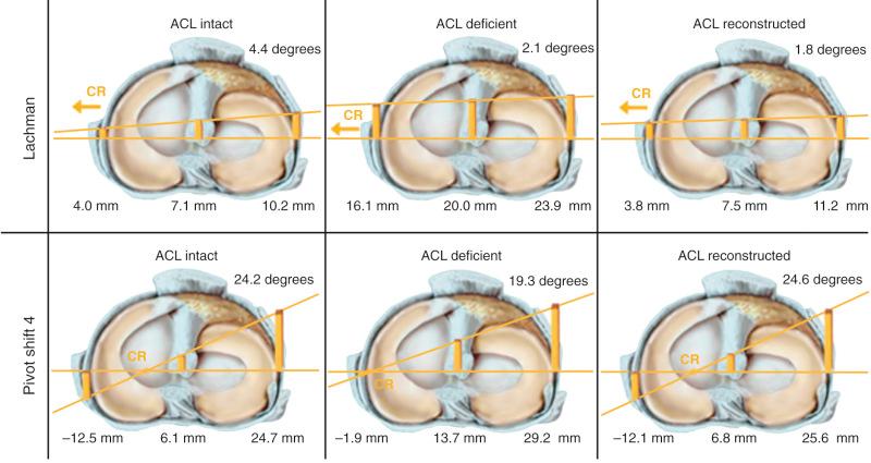 FIG 7-28, Compartment maps of a representative right knee specimen under the Lachman (100 N) and pivot shift 4 loading conditions (100-N anterior, 1 N-m internal rotation, 7 N-m valgus) for intact, anterior cruciate ligament (ACL)-deficient, and ACL-reconstructed conditions. A single bone-patellar tendon-bone graft placed in the central tibial and femoral ACL attachment sites restored translational and rotational stability, as measured by tibiofemoral compartment translations. CR , Center of tibial rotation.