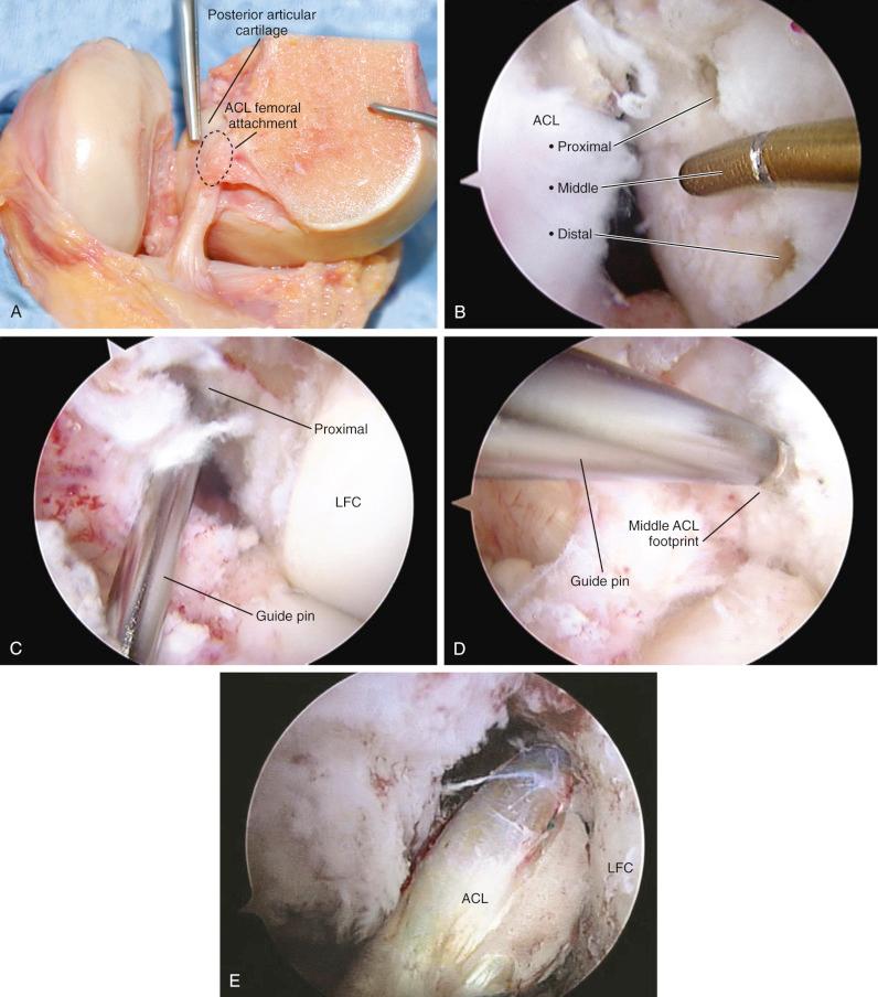 FIG 7-30, A, Anterior cruciate ligament (ACL) femoral attachment at 30 degrees of knee flexion (our preference rather than 90 degrees) shows the entire attachment on lateral wall of notch. B, Three points identified in proximal, middle, and distal portions of ACL attachment. C, Transtibial guide pin placement reaches only proximal one third of ACL attachment with a portion of the femoral tunnel extending onto the notch roof when a central ACL tibial tunnel is used. D, ACL central point reached with knee hyperflexion and anteromedial portal or with two-incision rear-entry technique. E, Final graft appearance on lateral wall. LFC, Lateral femoral condyle.