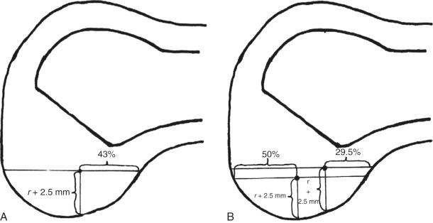 FIG 7-31, A, Sagittal section drawings representing the lateral wall of the intercondylar notch, right femur, with mean anatomic centrum of the anterior cruciate ligament (ACL) femoral footprint marked. A, The anatomic centrum of the ACL femoral footprint is 43% of the proximal to distal length of the lateral, femoral intercondylar notch wall and femoral socket radius (r) plus 2.5 mm anterior to the posterior articular margin. B, The anatomic centrum of the ACL femoral footprint anteromedial bundle (point on right) is 29.5% of the proximal to distal length of the lateral, femoral intercondylar notch wall. The anatomic centrum of the ACL femoral footprint posterolateral bundle (point on left) is 50% of the proximal to distal length of the lateral, femoral intercondylar notch wall. From posterior to anterior, the anteromedial bundle appears slightly anterior to the posterolateral bundle, and both bundles appear as r (socket radius) + 2.5 mm anterior to the posterior cartilage margin.