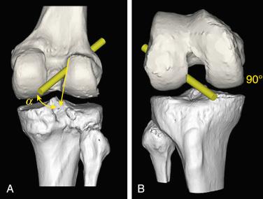 FIG 7-32, Three-dimensional model showing different transverse drill angles. A, Posterior view. B, Anterior view. α, angle at which the drill bit intersects the bone.