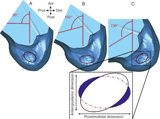 FIG 7-33, Examples of different knee flexion angles, where the anterior cruciate ligament (ACL) footprint is shown by the black oval lines and the tunnel aperture is shown by the red dotted lines. B, Overlapping ACL footprint and tunnel aperture at a knee flexion angle of 102 degrees. A and C, Mismatch between the ACL footprint and tunnel aperture in different knee flexion angles. The inset for C shows the resulting nonanatomic aperture area. Ant, anterior; Dist, distal; Prox, proximal.