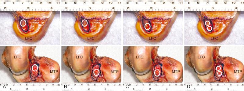 FIG 7-34, Summary of different femoral and tibial graft positions that are possible using anteromedial (AM) and posterolateral (PL) bundle terminology. A, Classic AM femur to PL tibia results in a vertical graft with a tibial tunnel placed too far posteriorly. B, A more central tibial tunnel is advantageous for control of rotational stability. C, The ideal central femoral-tibial tunnel locations for a single graft reconstruction. D, The placement of a two-bundle anterior cruciate ligament reconstruction. LFC, Lateral femoral condyle; MTP, medial tibial plateau.