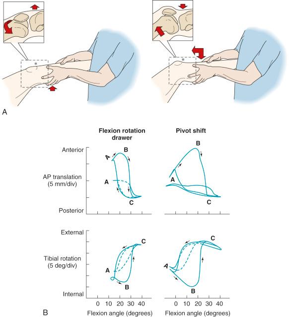 FIG 7-5, Flexion-rotation drawer and pivot shift tests. A, With the leg held in neutral rotation, the weight of the thigh causes the femur to drop back posteriorly and rotate externally, producing anterior subluxation of the tibial plateau. Gentle flexion and a downward push on the leg reduce the subluxation. This test allows the coupled motion of anterior translation-internal rotation to produce anterior subluxation of the lateral and medial tibial plateau. B, The knee motions during the tests are shown for tibial translation and rotation during knee flexion. The clinical test is shown for the normal knee ( dotted line ) and after ligament sectioning ( solid line ). The ligaments sectioned were the anterior cruciate ligament (ACL), iliotibial band, and lateral capsule. Position A equals the starting position of the test, B is the maximum subluxated position, and C indicates the reduced position. The pivot shift test involves the examiner applying anterior translation and rotational loading to produce the tibial subluxation. The actual changes in the motion limits are shown later where there are major increases in lateral and medial tibiofemoral compartment translations and only small changes in degrees of internal tibial rotation. AP, Anteroposterior; div, division.