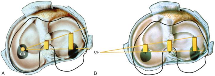 FIG 7-6, Intact knee and after anterior cruciate ligament (ACL) sectioning: response to coupled motions of anterior tibial translation and internal tibial rotation. A, Intact knee. The center of rotation (CR) may vary between the medial aspect of the posterior cruciate ligament and meniscus border, based on the loads applied and physiologic laxity of the ligaments. B, ACL sectioned; note shift in center of tibial rotation medially. The effect of the increase in tibial translation and internal tibial rotation produces an increase in medial and lateral tibiofemoral compartment translation (anterior subluxation). The millimeters of anterior translation of the tibiofemoral compartments represents the most ideal method to define knee rotational stability (see Chapter 3 ). The center of rotation under a pivot shift type of test shifts to the intact medial ligament structures. If these are deficient, the center of rotation shifts outside the knee joint.