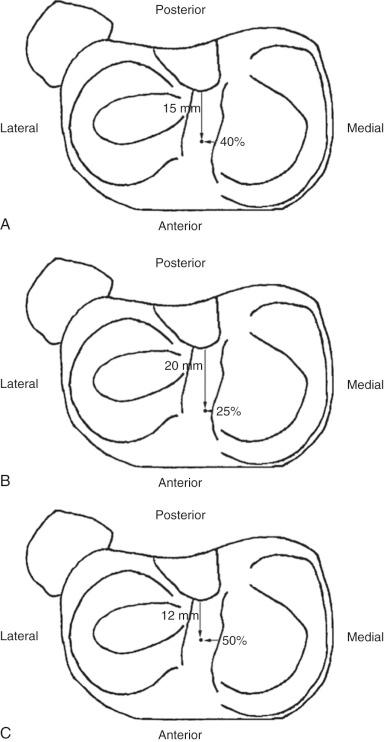 FIG 7-10, Illustrated is the proximal tibia and anterior border of the posterior cruciate ligament (PCL). Between the menisci, lines running from superior to inferior represent the lateral (left) and medial (right) intercondylar eminences (tibial spines). A, The black dot represents the centrum of the anterior cruciate ligament (ACL) tibial footprint as a whole, located approximately 15 mm anterior to the PCL and approximately two fifths the interspinous distance from the medial to the lateral intercondylar eminence. B, The black dot represents the centrum of the ACL tibial anteromedial bundle footprint, located approximately 20 mm anterior to the PCL and approximately one fourth the interspinous distance from the medial to the lateral intercondylar eminence. C, The black dot marks the centrum of the ACL tibial posterolateral bundle footprint, located approximately 12 mm anterior to the PCL and approximately one half the interspinous distance from the medial to the lateral intercondylar eminence.