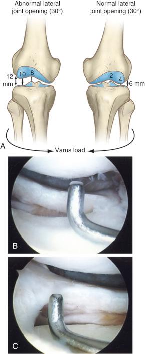 FIG 8-1, The gap test. A, The amount of lateral tibiofemoral joint opening is measured with the knee at 25 degrees of flexion. Knees with insufficiency of the posterolateral structures will demonstrate 12 mm of joint opening at the periphery of the lateral tibiofemoral compartment, 10 mm at the midportion of the compartment, and 8 mm at the innermost medial edge. B, Normal gap test. C, Abnormal gap test.