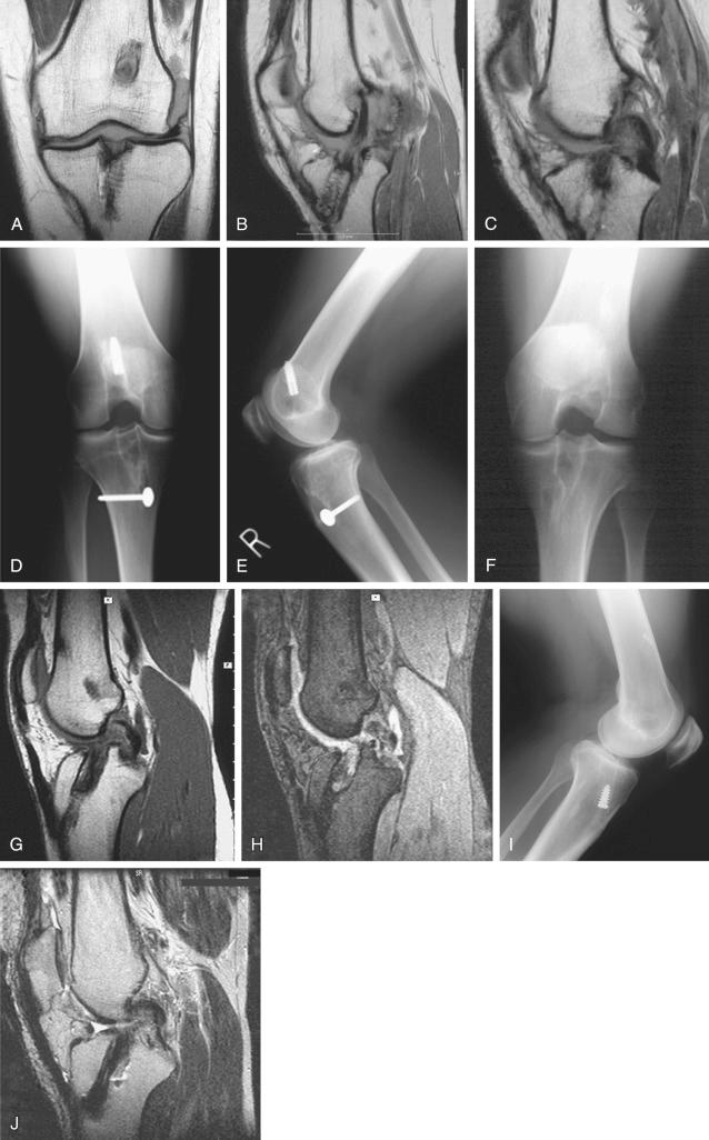 FIG 8-2, A series of four cases with enlarged tibial tunnels and vertical anterior cruciate ligament (ACL) graft orientation requiring staged bone grafting before ACL revision surgery. ( A to C, case 1; D and E, case 2; F to H, case 3; I and J, case 4.) Often, the radiograph underestimates the extent of tunnel widening requiring bone grafting. If these tibial tunnels were accepted for a revision graft, the graft placement would remain too posterior, not in the ideal ACL central attachment, and a snug graft tunnel interface would not be established. Accordingly, bone grafting was required in all cases before revision surgery.